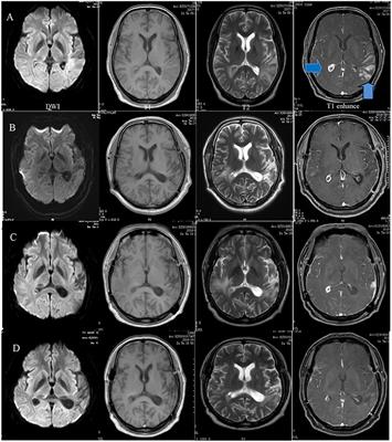 Multiple Distinctive Demyelinating Lesions Caused by Eosinophilic Granulomatosis With Polyangiitis: Case Report and Literature Review